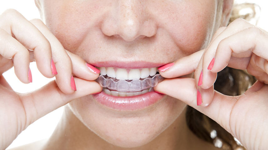 How Long You Have to Wear Invisalign and Why You Need To How Long You Have to Wear Invisalign and Why You Need To