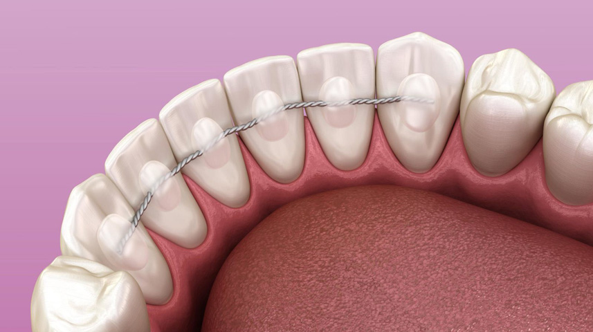 Retainer