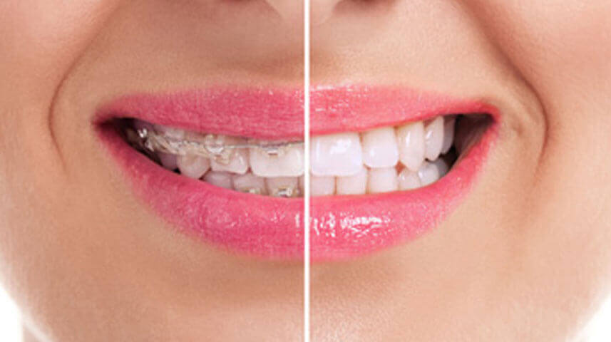 How Do I Know if I Need Orthodontics? How Do I Know if I Need Orthodontics?